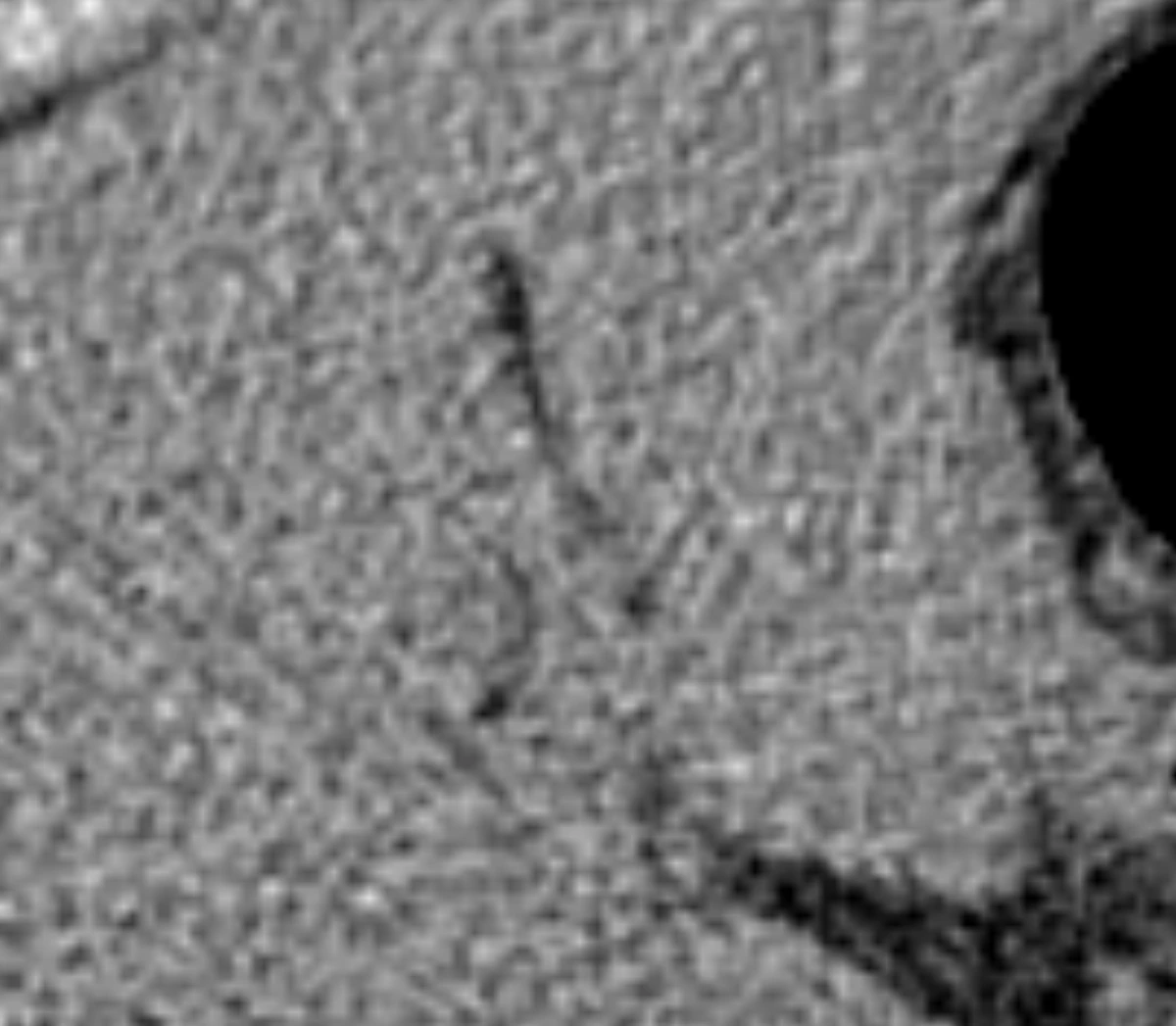 CT slice at W400/L40, detail at 3.75× app zoom, Denoise off