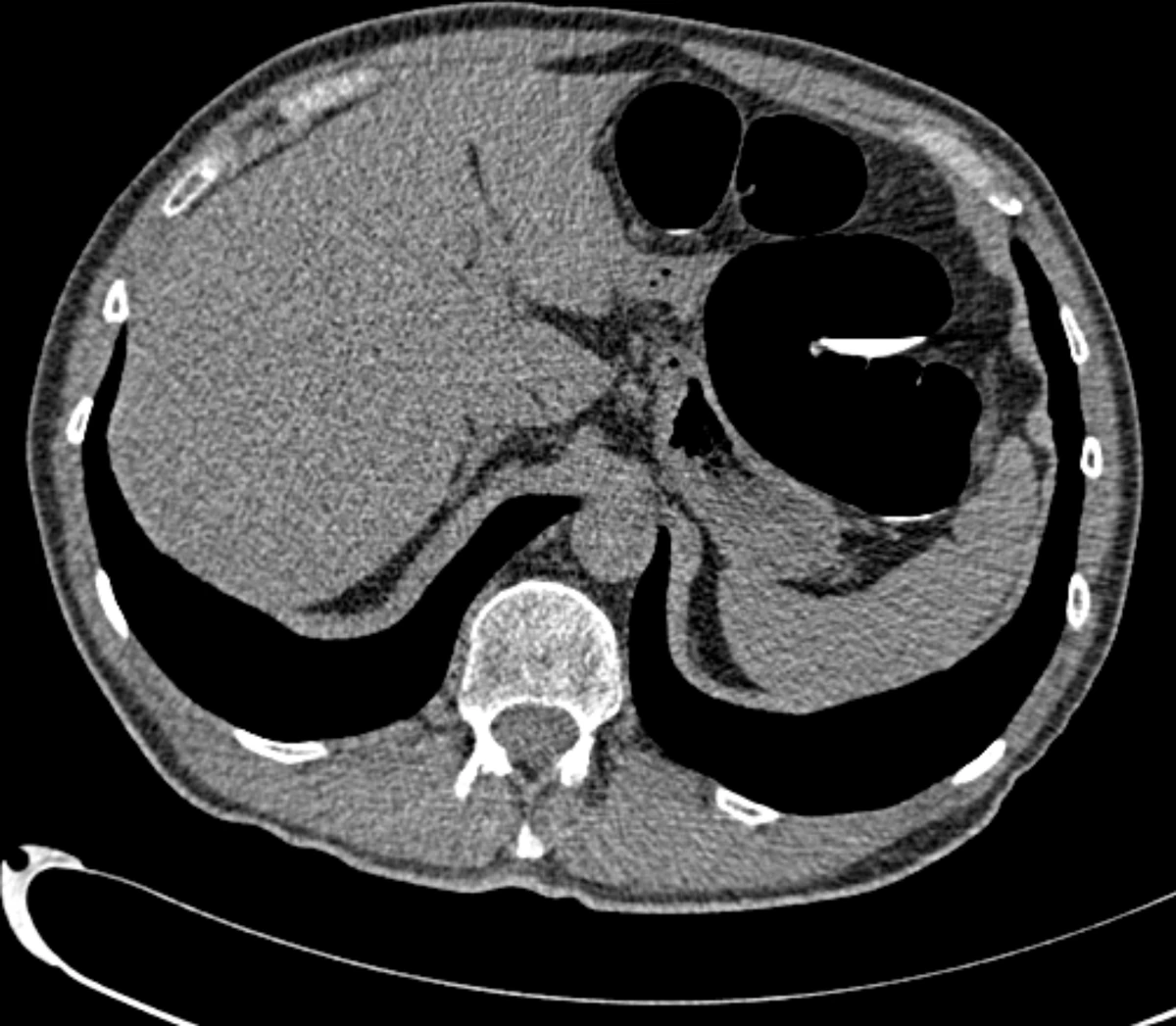 CT slice at W400/L40, whole slice, Denoise off